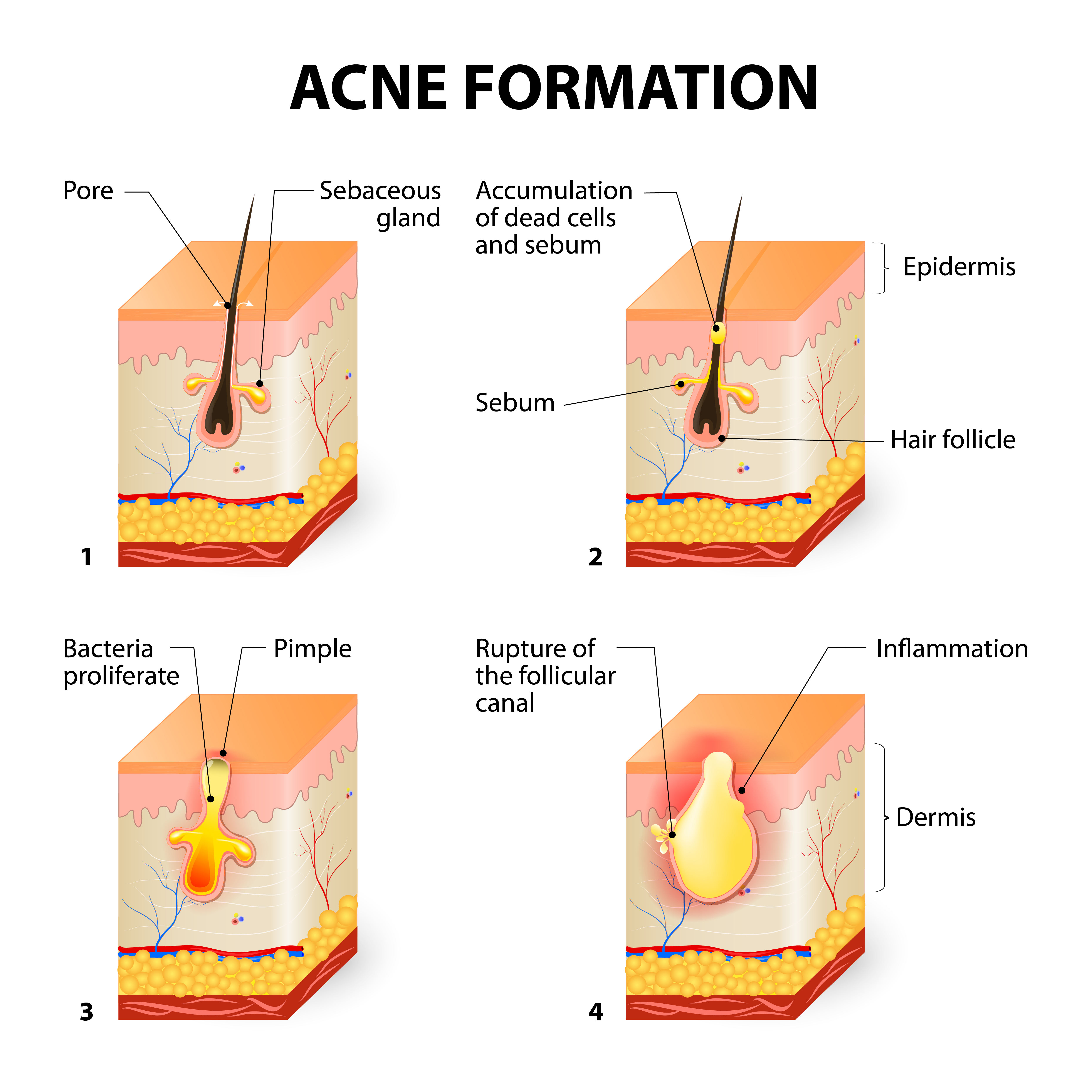 Formation of Acne