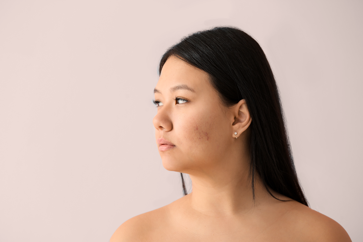 Purging-vs-Breakouts