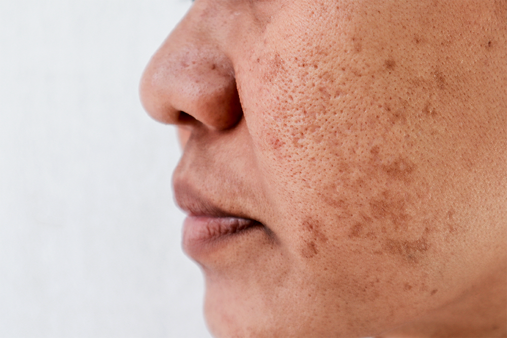 What-is-Pigmentation-Blog-Image