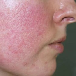 Erythematotelangiectatic Rosacea