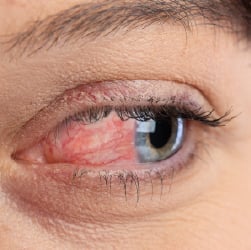 Ocular Rosacea