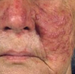 Phymatous Rosacea