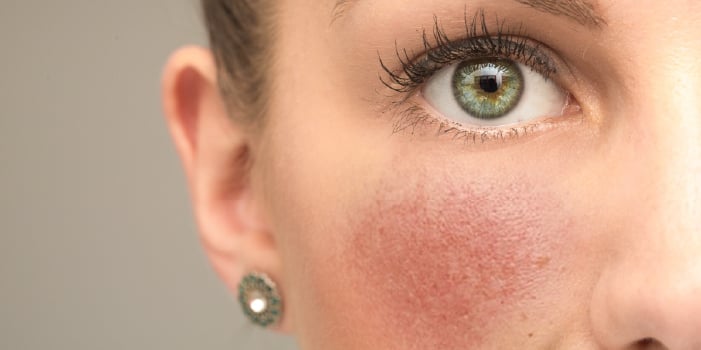 Woman with rosacea symptoms on her face