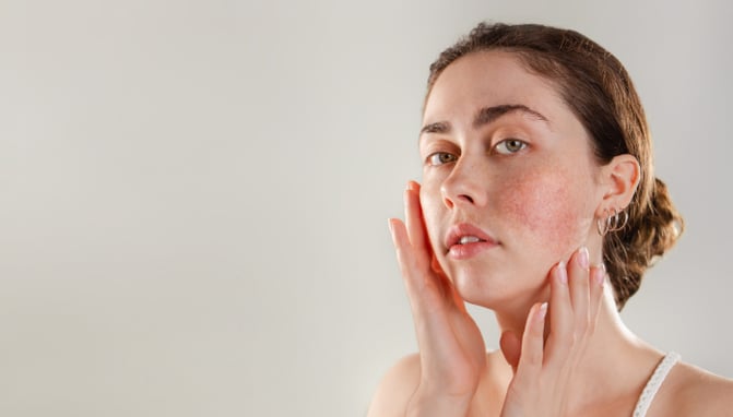 Woman who has reduced rosacea symptoms with GlyMed Plus skin care