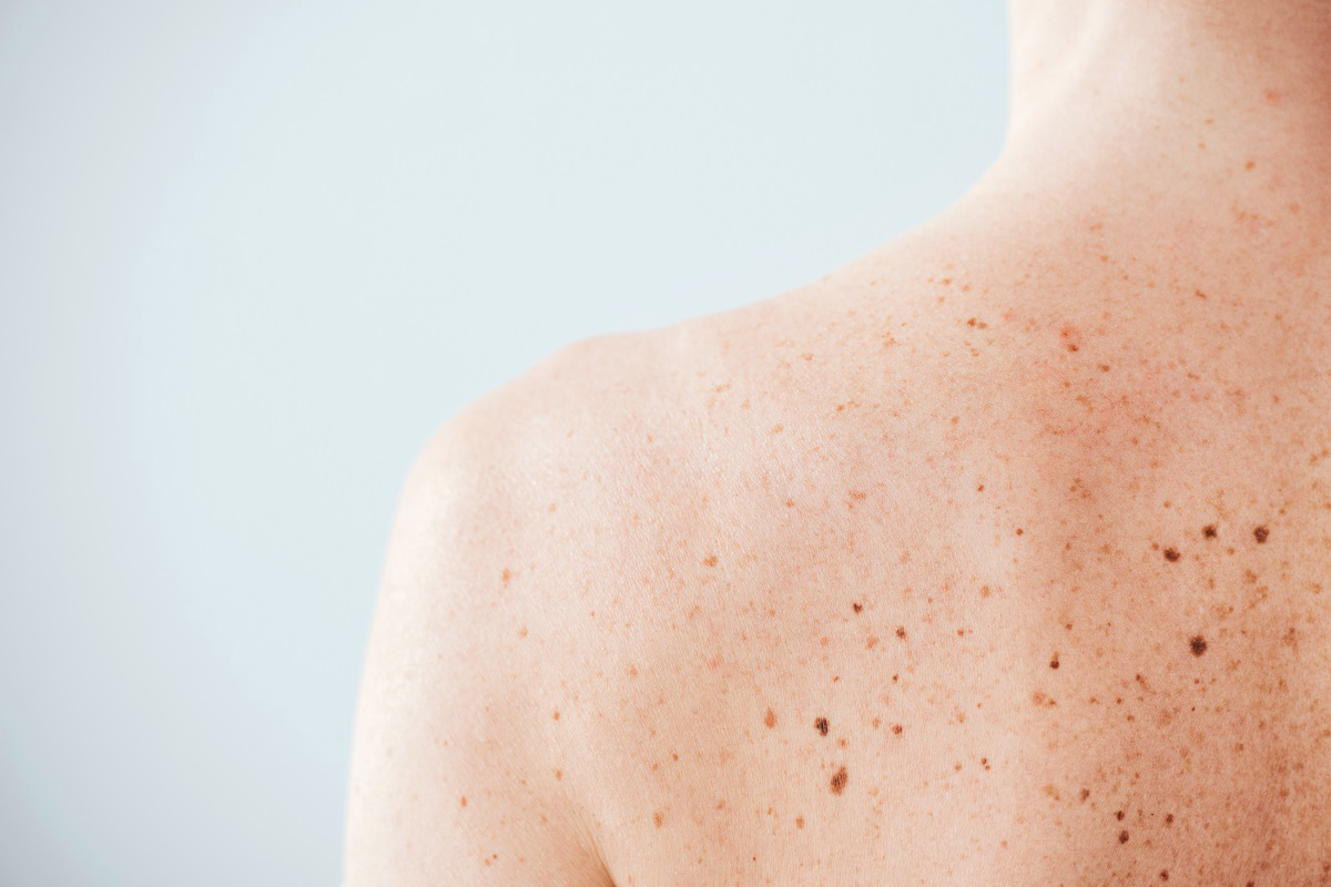 Skin-Cancer-Awareness