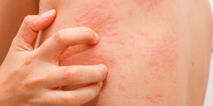 A woman scratches her allergy-effected skin