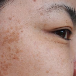 Woman with age spots on her face.