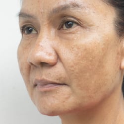 Woman with melasma on her face.