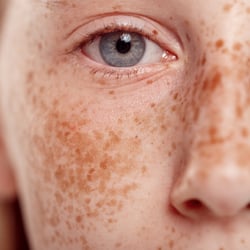 Fair-skinned woman with freckles on her face.