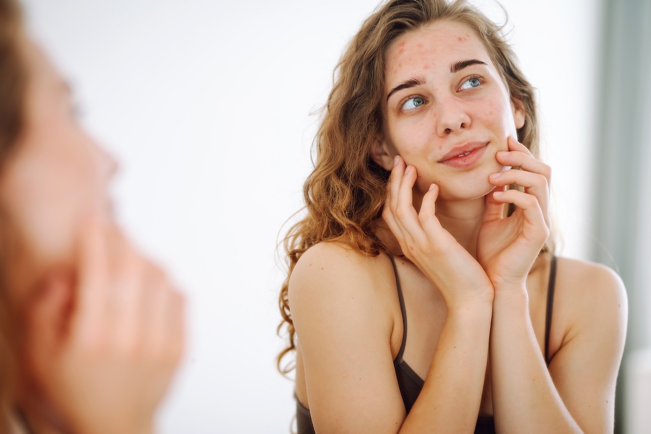 young woman experiencing acne as a pcos symptom