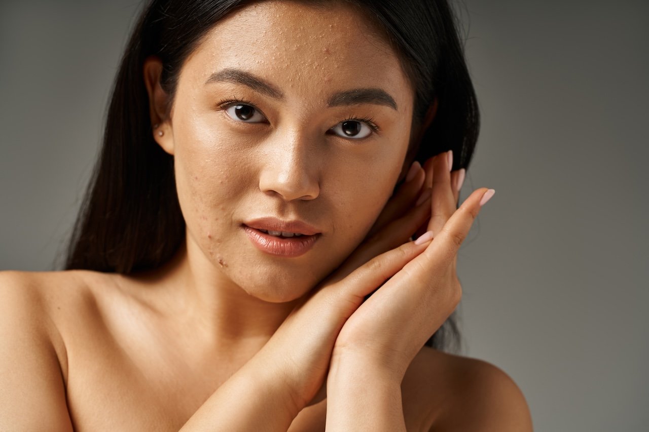 young woman with acne