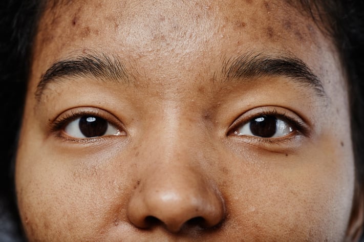 closeup of woman with dark spots from acne