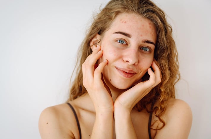 woman with acne holds her face and smiles softly