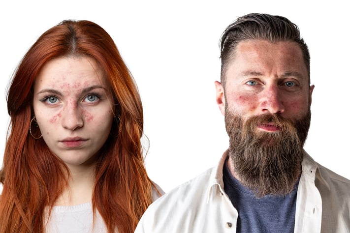 man and woman with visible rosacea